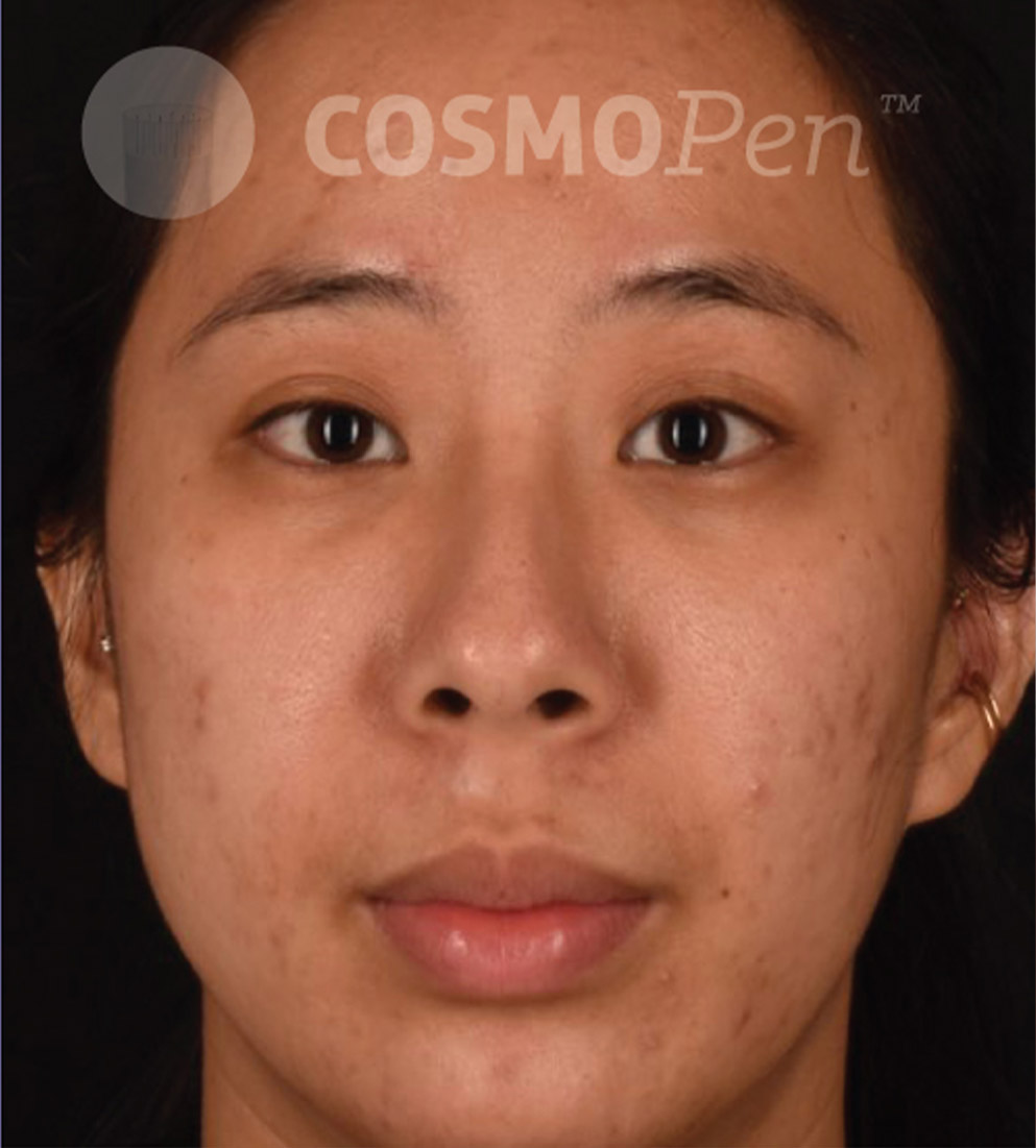 Psi Cosmopen Results B After