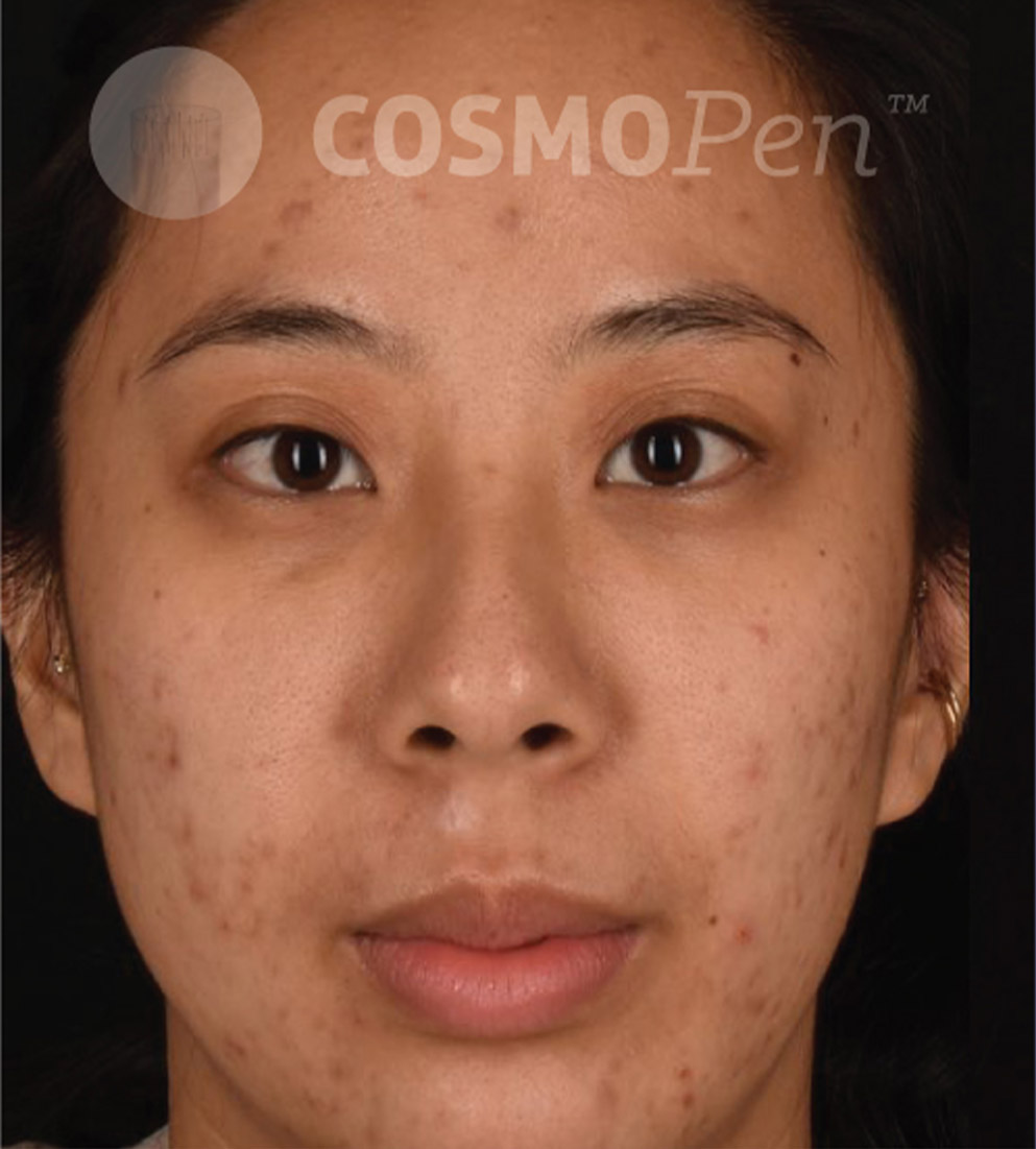 Psi Cosmopen Results B Before