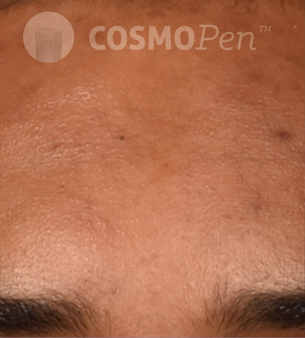 Psi Cosmopen Results C After