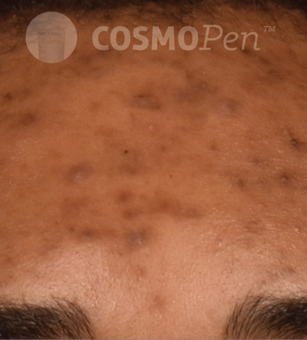 Psi Cosmopen Results C Before