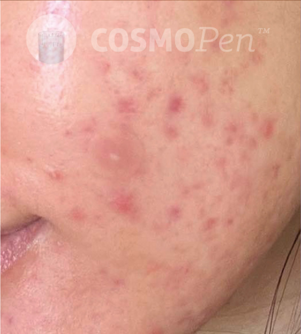 Psi Cosmopen Results D Before