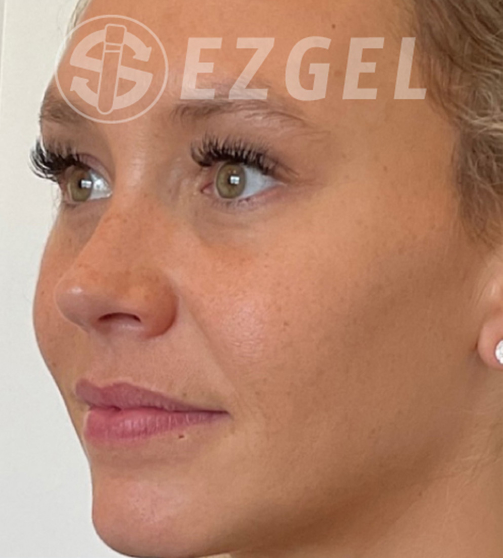 Psi ezgel a after