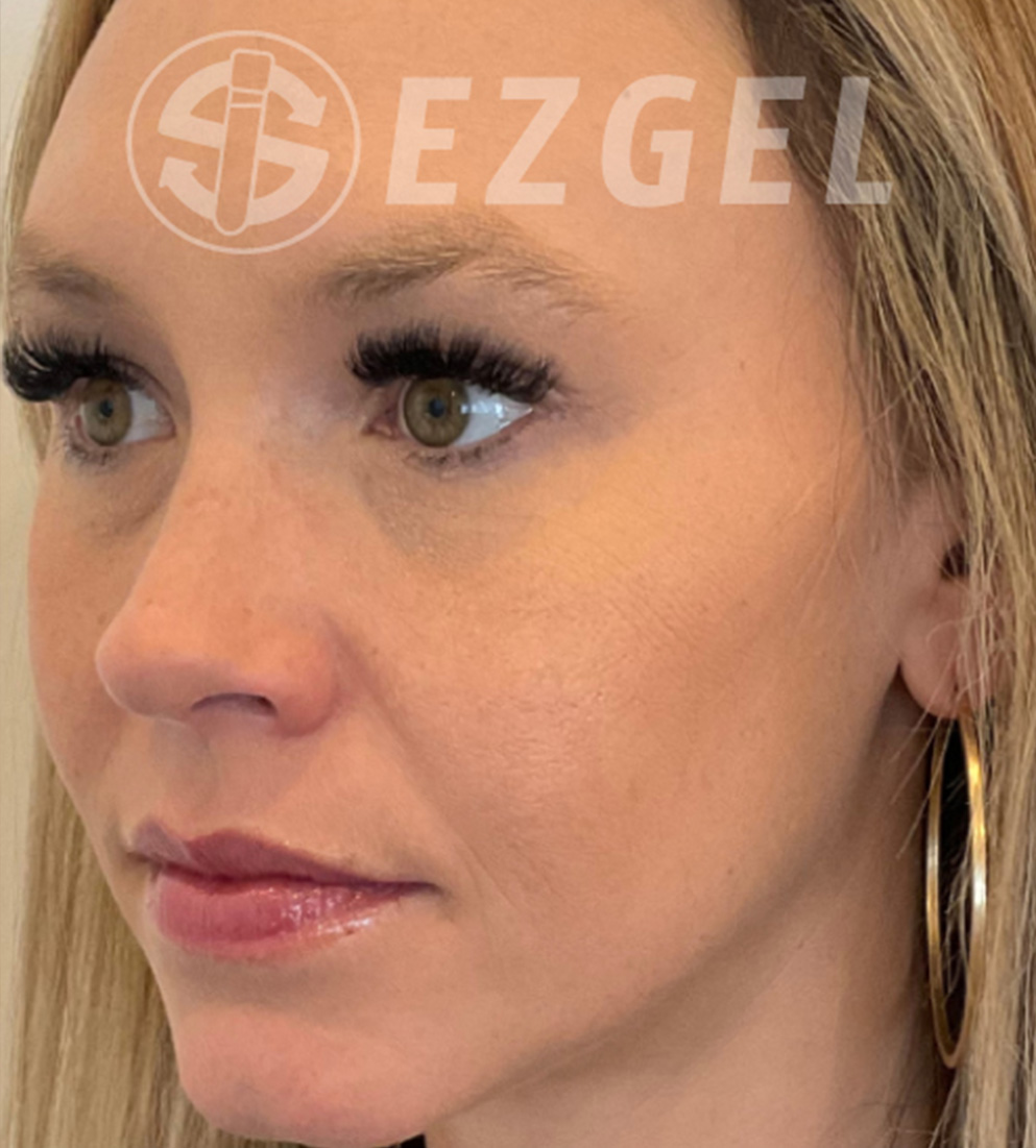 Psi ezgel a before