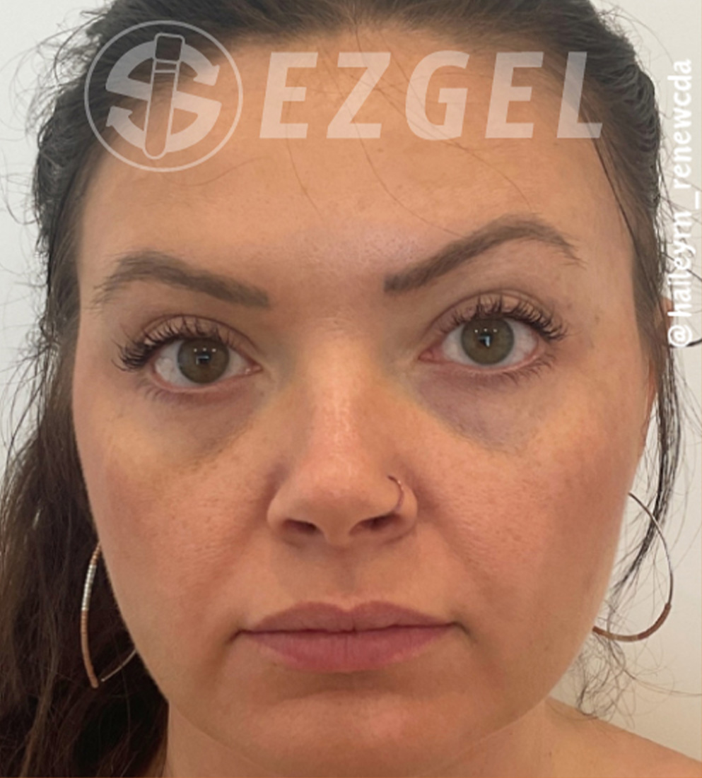 Psi ezgel d before