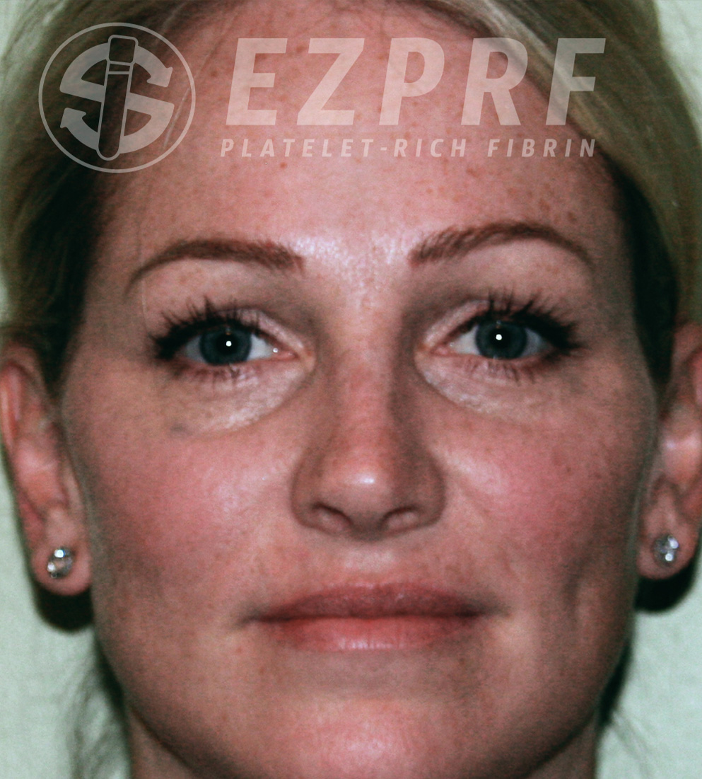 Psi ezprf face a