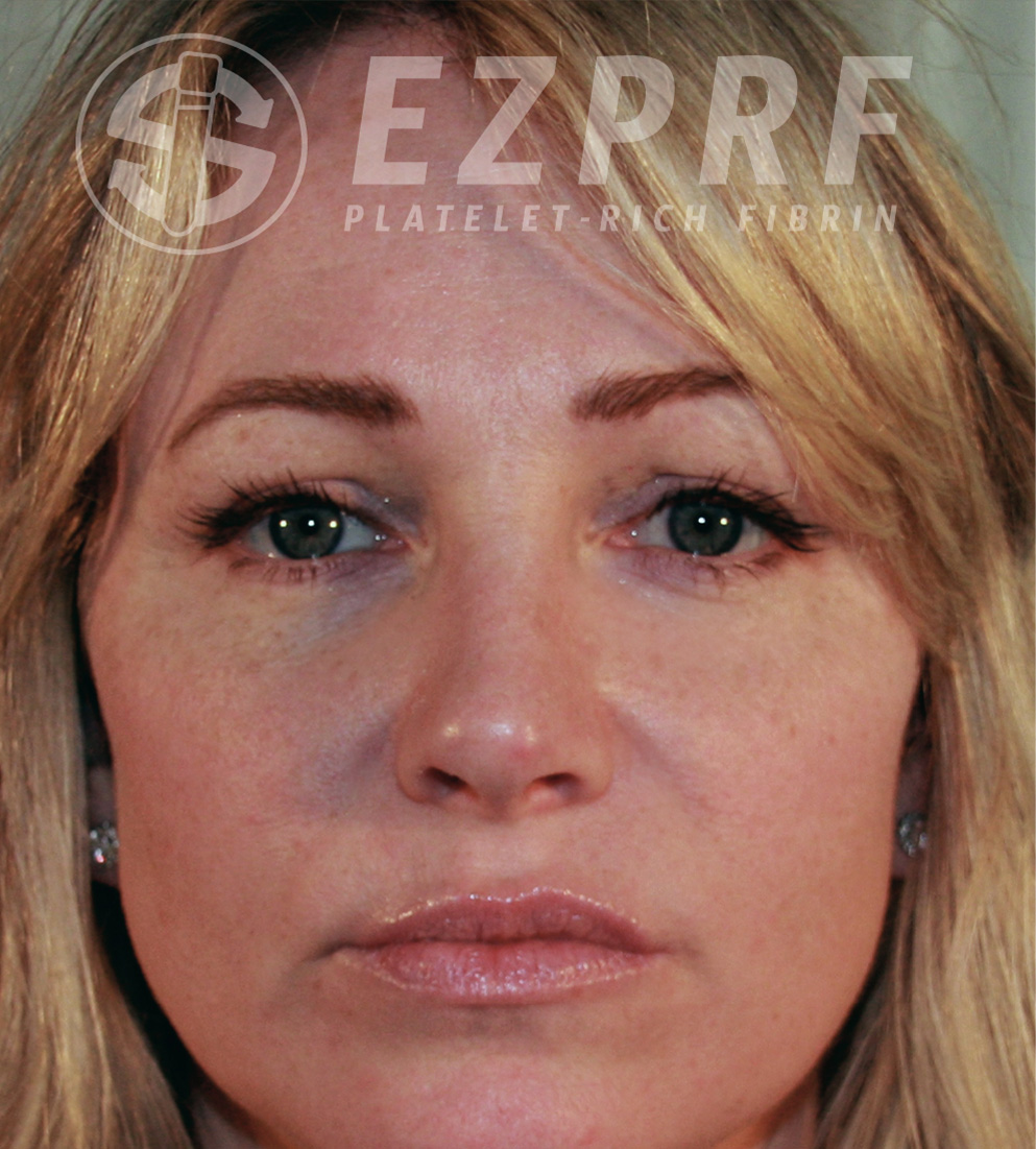 Psi ezprf face b