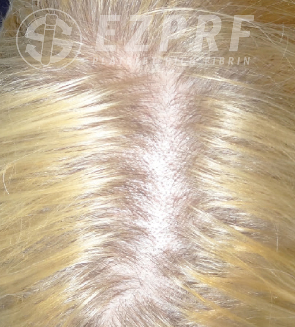 Psi ezprf hair a